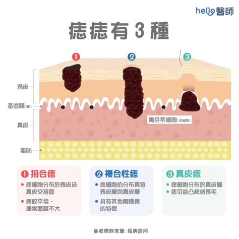 會長大的痣|痣變大、痣多或長毛會變皮膚癌？認識痣的形成與原因